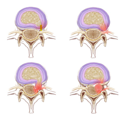 Protrusión discal