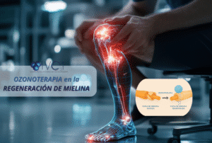Ozonoterapia en la regeneración de mielina