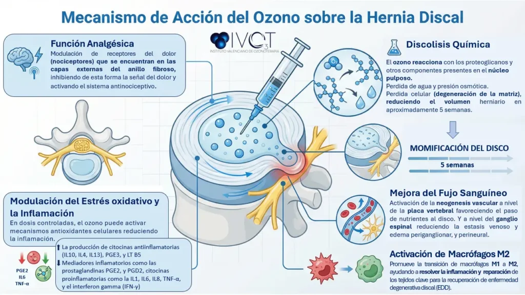 ozonoterapia en la hernia discal